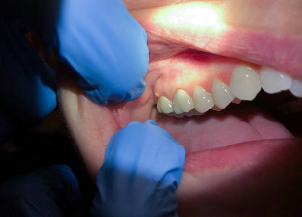 Best Tooth Infection Emergency Dentist  in Orange Beach, AL